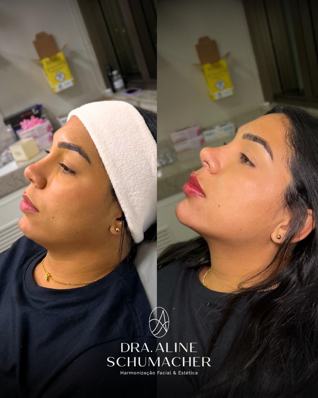 Antes e depois 1