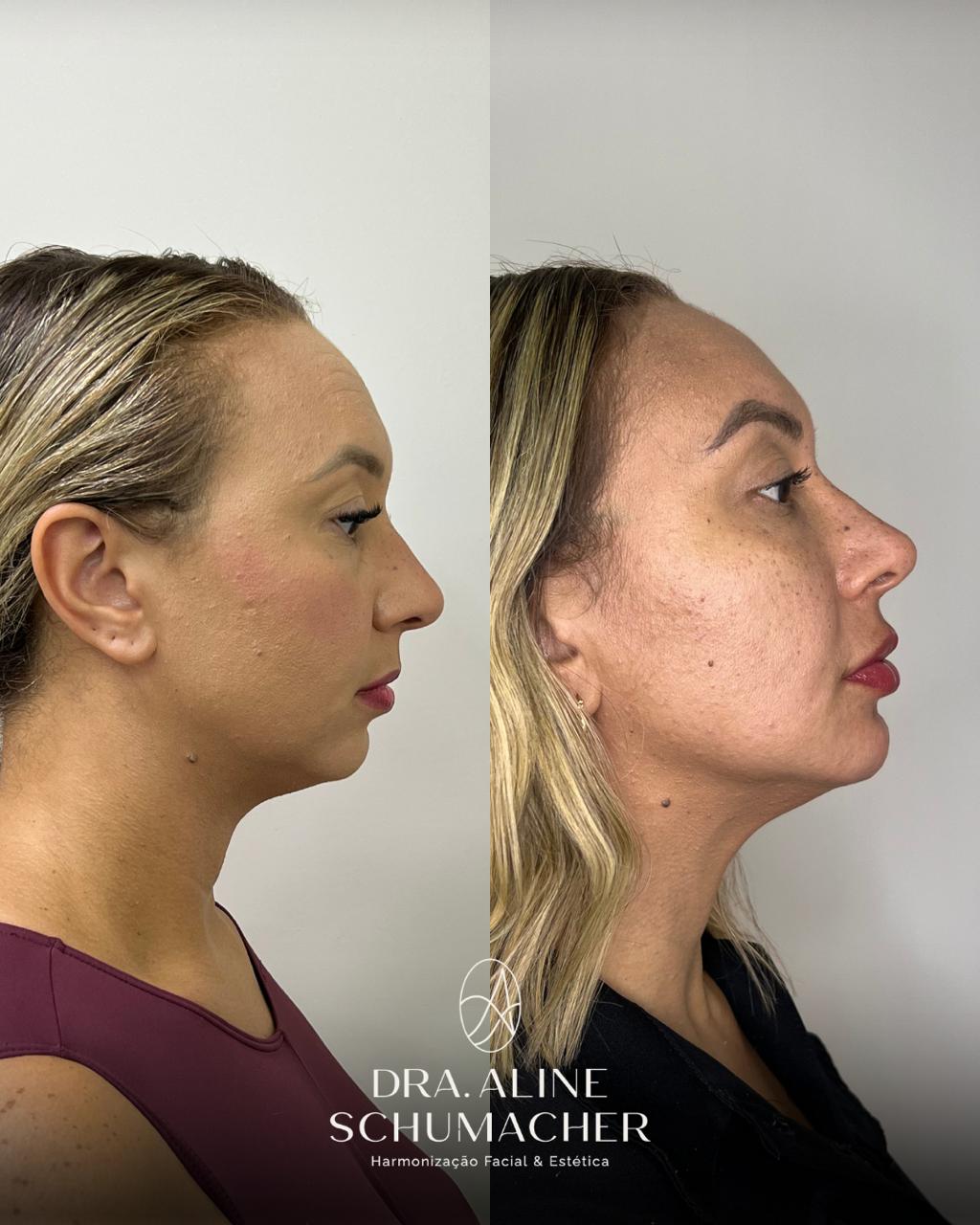 Antes e depois 2